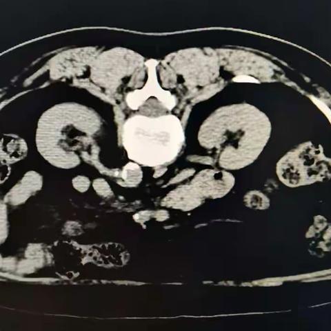 我科肾穿刺活检一例