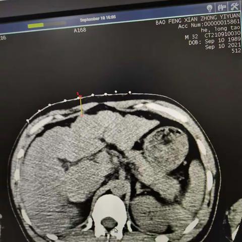 酒精性肝硬化一例