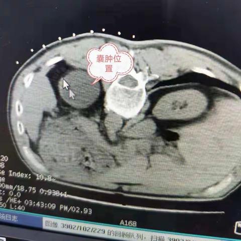 我科完成一例肾囊肿穿刺硬化术