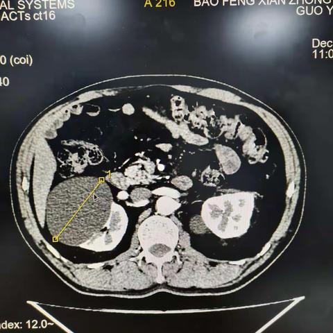 老年病科腔内置软管引流硬化一例巨大肾囊肿