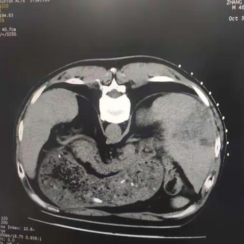 老年病科成功开展一例肝占位穿刺活检