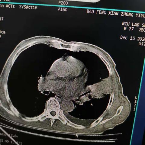 我科两小时完成两例肺占位穿刺活检