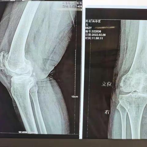 双膝关节骨性关节炎  双膝关节人工膝关节表面置换术