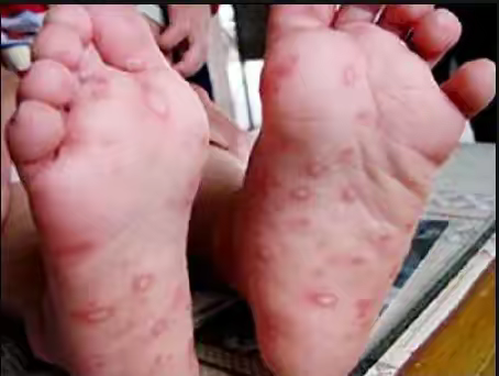 【周医·感染科】预防手足口，从你我做起