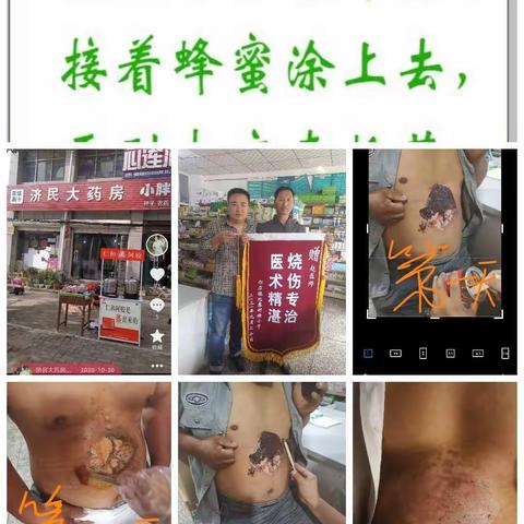 在日常的生活中，火是必不可少的东西，但是经常会因为它而引起不必要的烧伤和烫伤，而一但人被烧伤之后，对人体