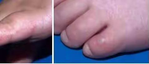 手足口病的预防措施