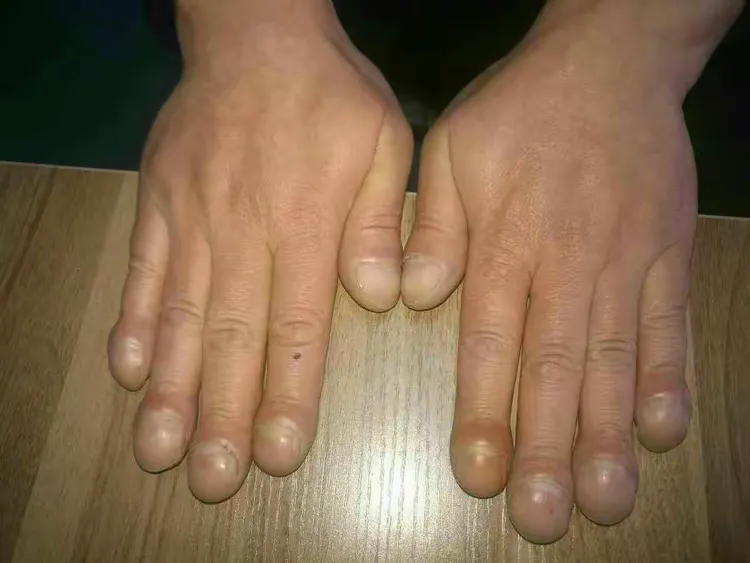 杵状指～这个症状不少见，但就是这个不痛不痒但一直持续加重的症状，困扰了张先生26年。张先生多年来多方