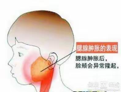 大路镇小精灵幼儿园—腮腺炎预防宣传