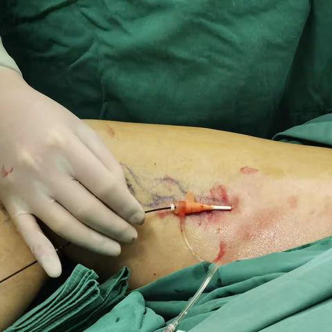 Covid咨询日记（七）：感染与血栓