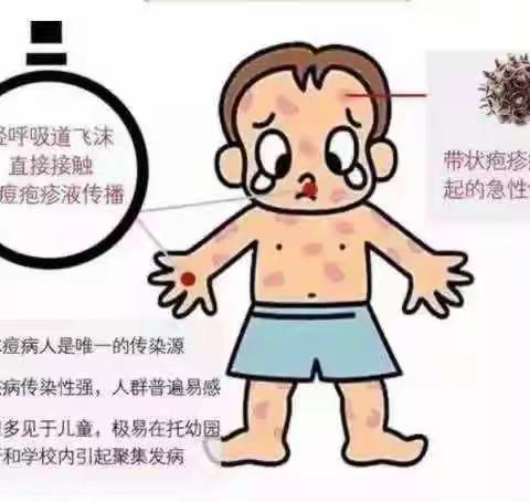 认识水痘，一起“战痘”