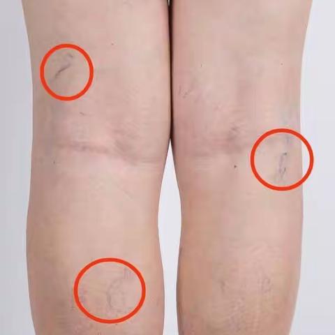 论下肢静脉曲张的康复治疗