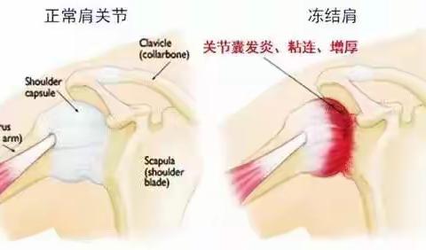 肩周炎恢复性训练