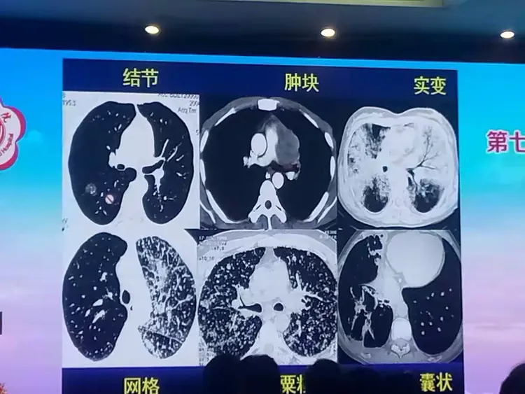 肺部间质性病变