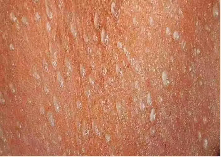 新生儿湿疹 热痱子