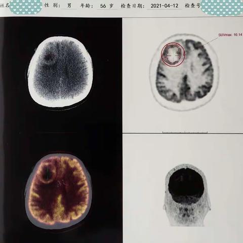 我院首例肝癌脑转移瘤放射性粒子植入手术顺利完成！