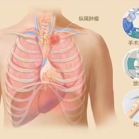 无需开刀！微创介入在肿瘤患者治疗中发挥巨大优势——2例125I粒子植入治疗纵隔部肿瘤病案报道