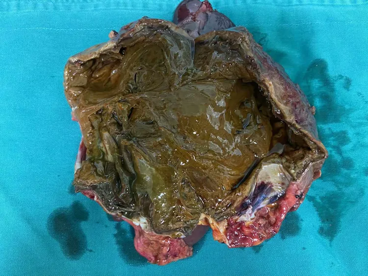 肝囊腺癌开腹左三肝切除 潘定宇主任病人