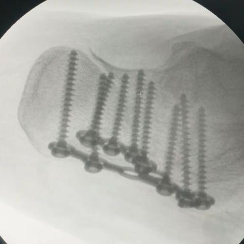 跟骨骨折