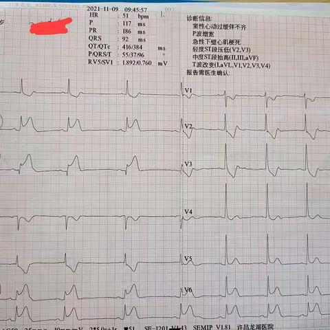 “要命”的急性心肌梗死！