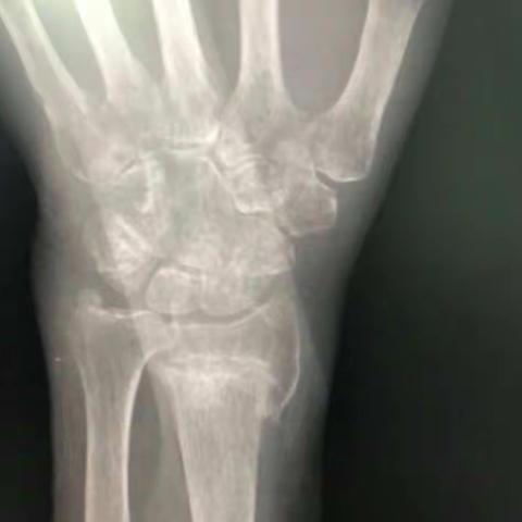 刘世森的及射阳康复医院的上肢骨折病例【二】