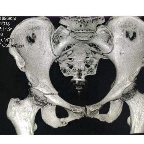 骨盆前和脊柱骨折的治疗【二】