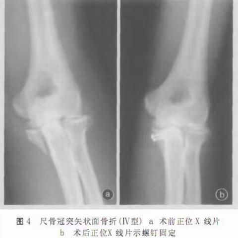 【专一骨折】——尺骨冠状突骨折治疗的有关文献复习！附射阳康复医院一例报告片片！