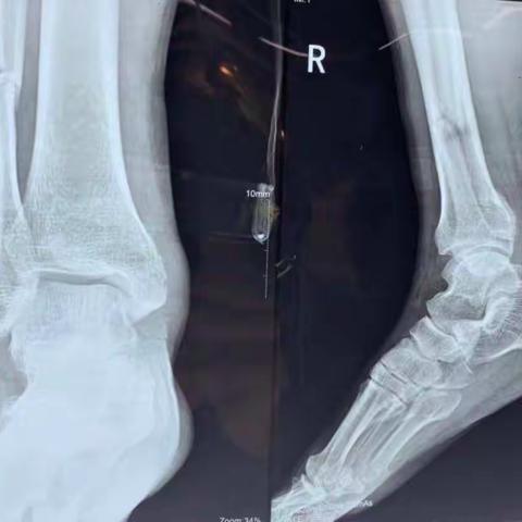 看CR或DR与CT骨关节损伤检查对治疗选择差异？【此“美篇医学资料”有类似临床病例经验交流】