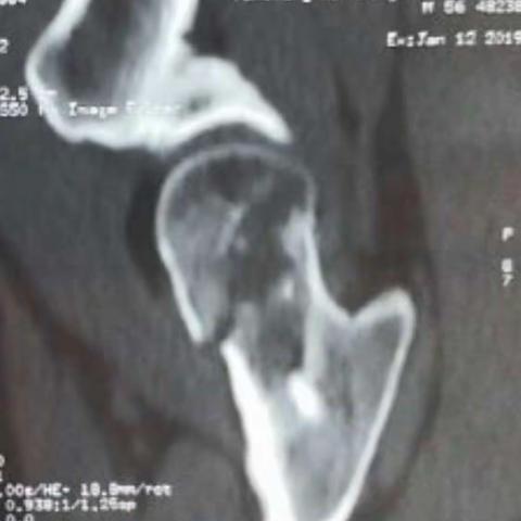 股骨颈骨折的治疗