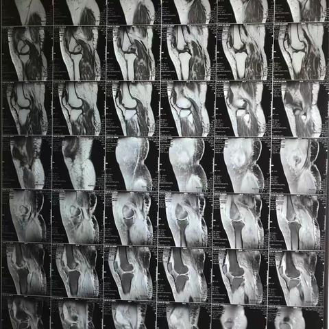 刘世森的和射阳康复医院骨科病例 下肢  （三）