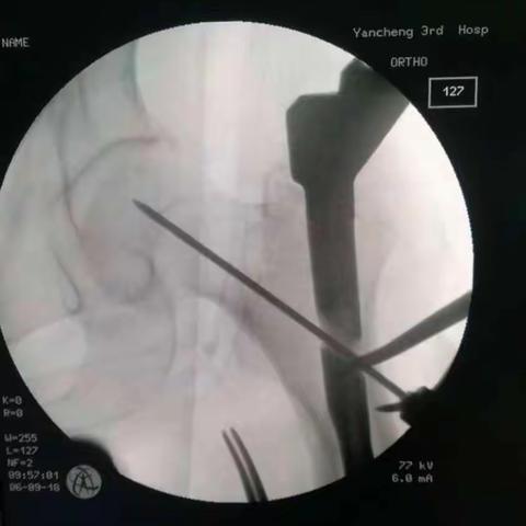 刘世森的及射阳康复医院的下肢骨折病例【二】