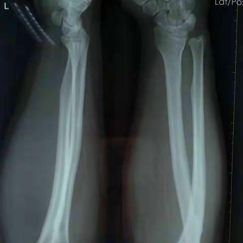 【专一骨折】——桡骨头骨折的治疗【附盐城附医穆洪鑫和射阳康复医院手术病例】及有关技术资料复习！