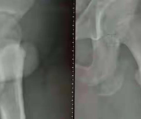 坐骨结节骨骺撕脱骨折如何治疗？【此“美篇医学资料”有类似临床经验交流！