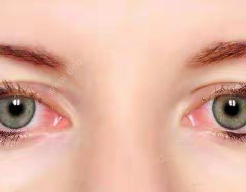 谈谈缓解眼睛红血丝的几个小妙招！