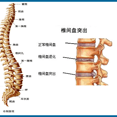 腰椎间盘突出的诊疗