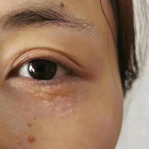 汗管瘤，不死的癌症！