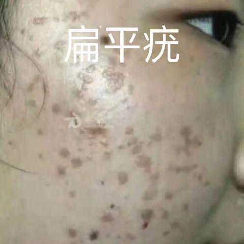 扁平疣、矢状疣、寻常疣