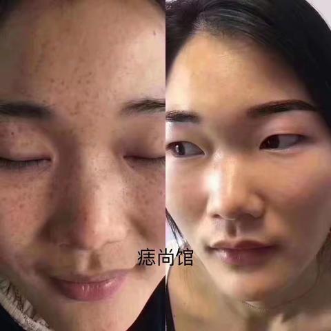 痣尚馆效果好不好只用事实说话！