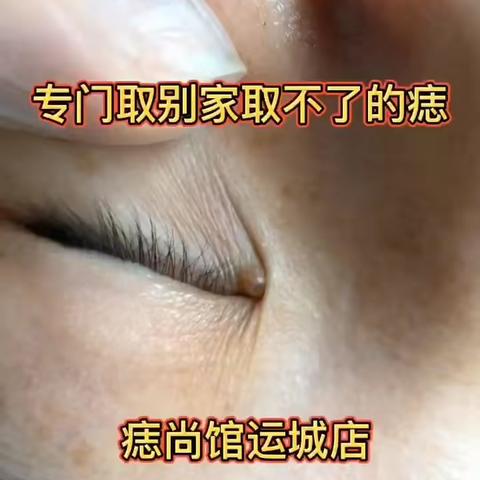 专门取别家取不了的痣