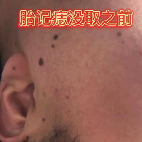 看看胎记痣取后十天的效果！