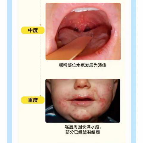 教师健康讲座-预防手足口病