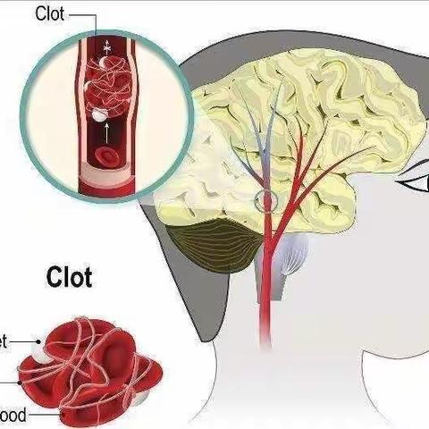脑梗塞早期有什么症状？做好这3件事，不怕脑梗找上门