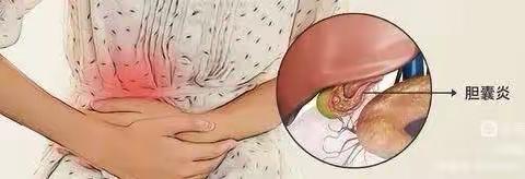 【丘北众康医院外一科】胆囊炎