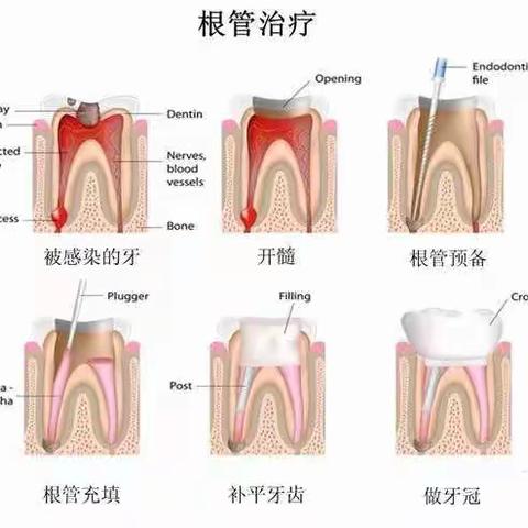 根管治疗与种植治疗一定要针锋相对？（第一篇）