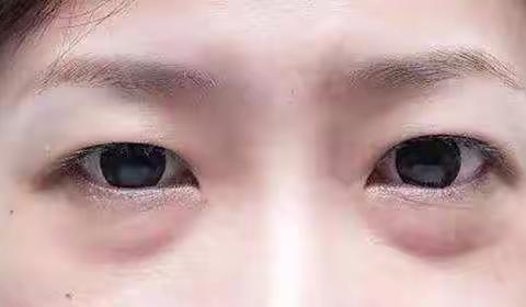 眼袋大一圈，显老十多岁！补好这个地方，眼袋跟你说再见