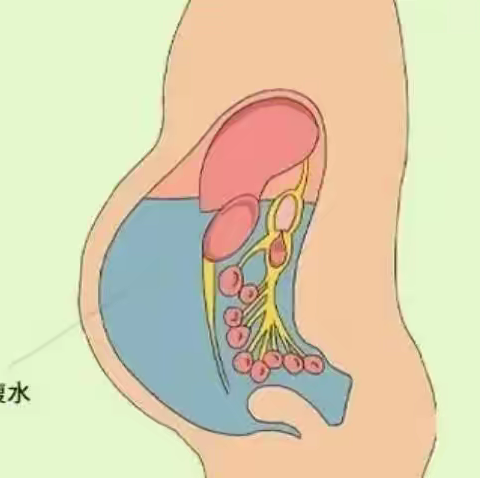 腹水还有分类吗，该怎么从根本上治疗？