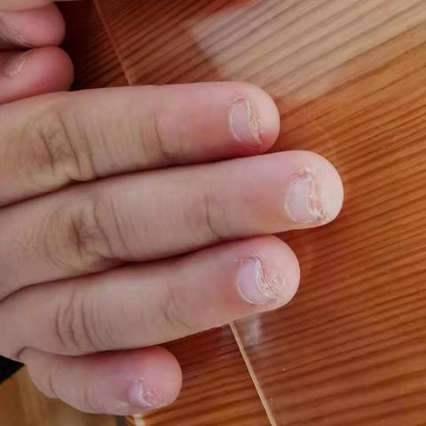 您一定要知道的幼儿咬指甲问题