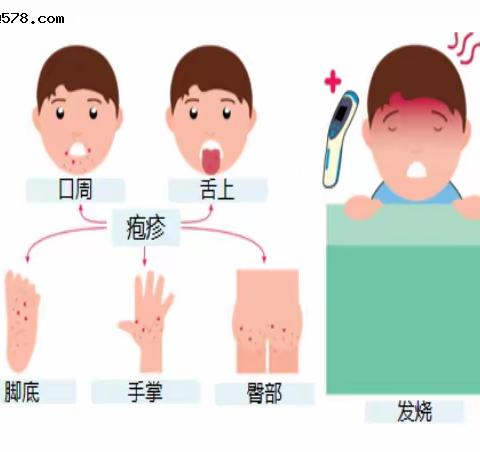 手足口病预防知识宣传篇