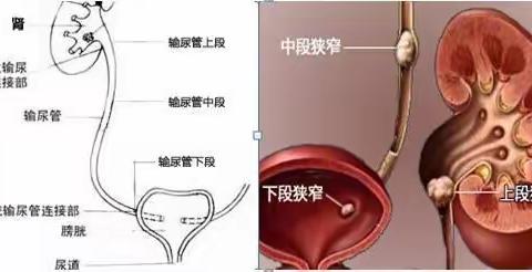 关于输尿管结石治疗再思考