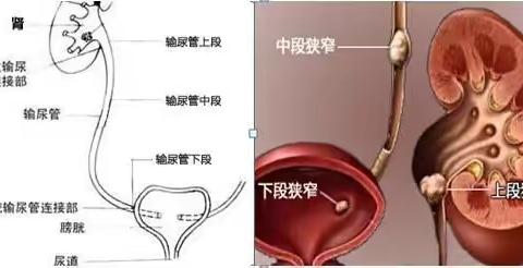 输尿管结石治疗经验分享