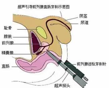 前列腺穿刺活检那些事儿